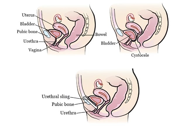 Cystocele